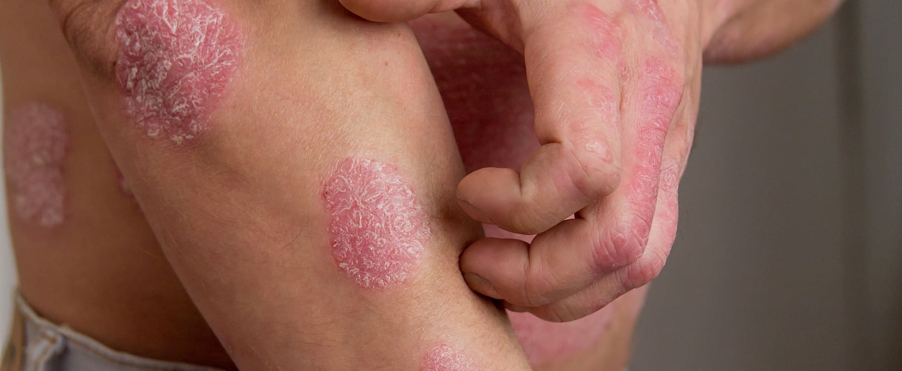 Psoriasis