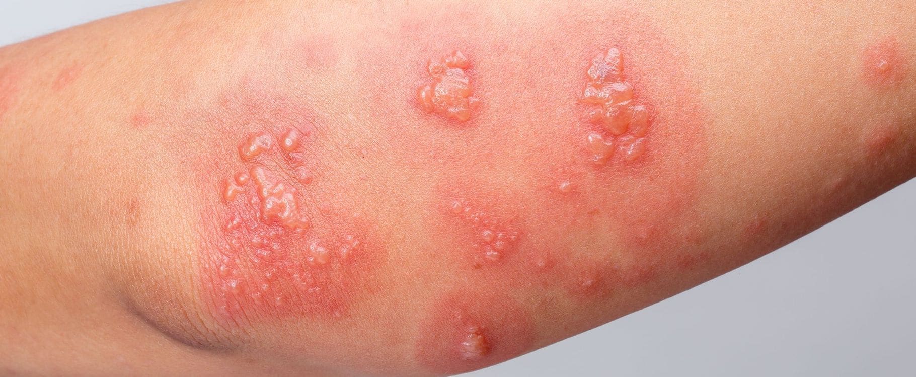 Dermatologic Care in Mesa, AZ Sagebrush Dermatology