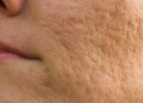 Acne scarring on a woman's face