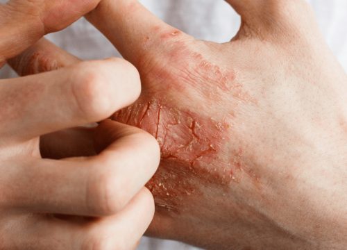Eczema on a man's hand
