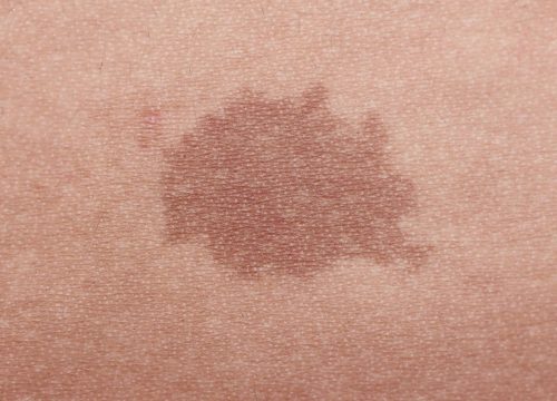 A birthmark on a person's skin