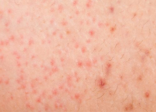 Folliculitis on a person's skin