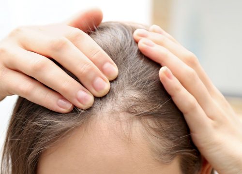 Woman experiencing Frontal Fibrosing Alopecia