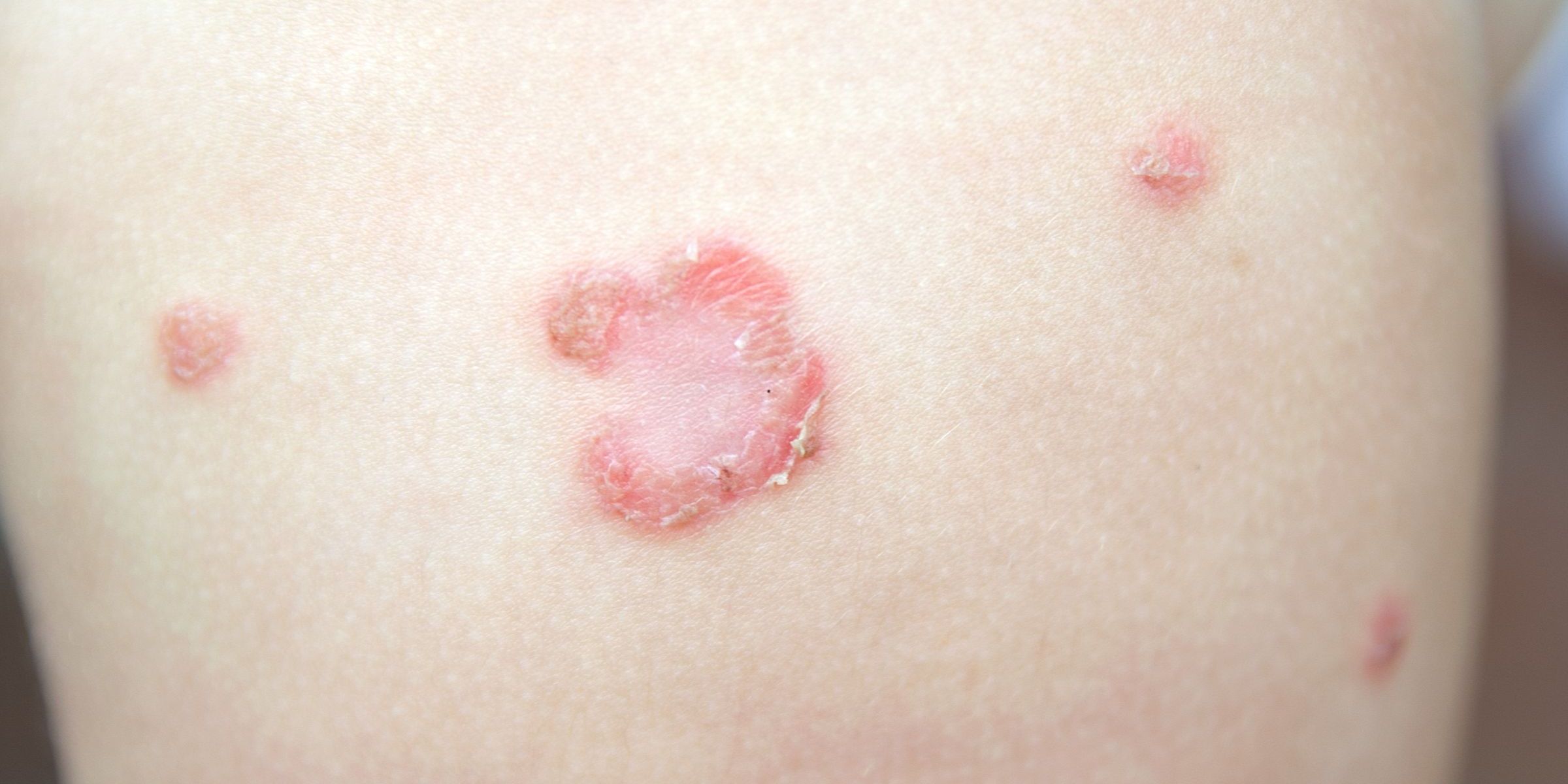 Impetigo Treatments Mesa, AZ Sagebrush Dermatology