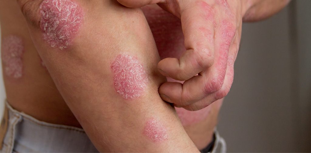 Psoriasis treatments mesa az sagebrush dermatology