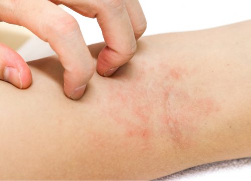 Rashes and hives on a person's arm