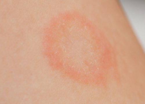 Ringworm on a person's body