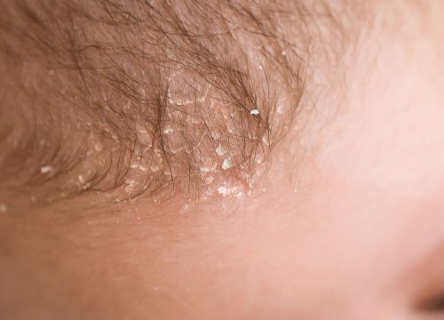 Seborrheic dermatitis on a baby's head