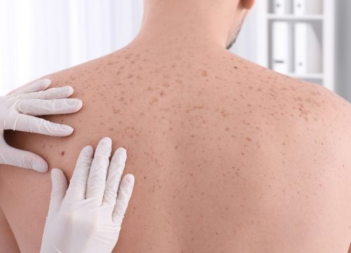 Dermatologist checking for skin cancer on a man's back