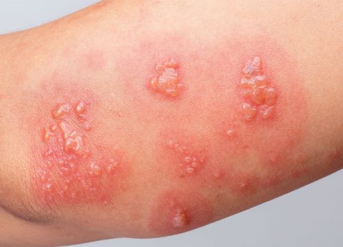 Skin infections on a person's arm