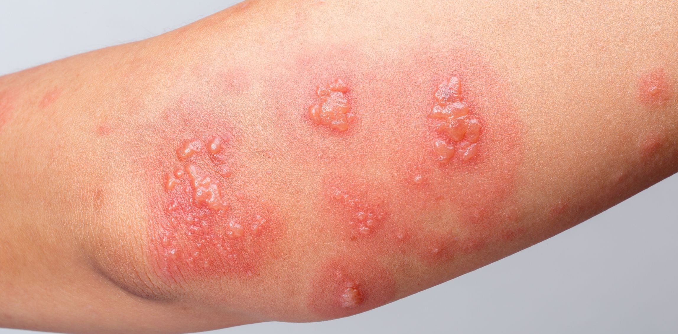 Skin Infections