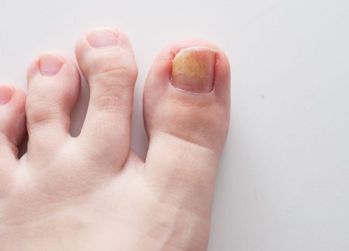 Toenail fungus on a person's foot
