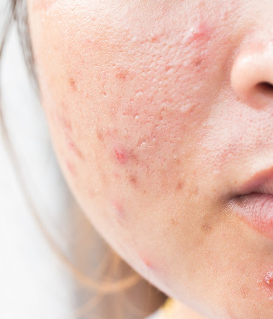 Close up on acne and scarring on a woman's face
