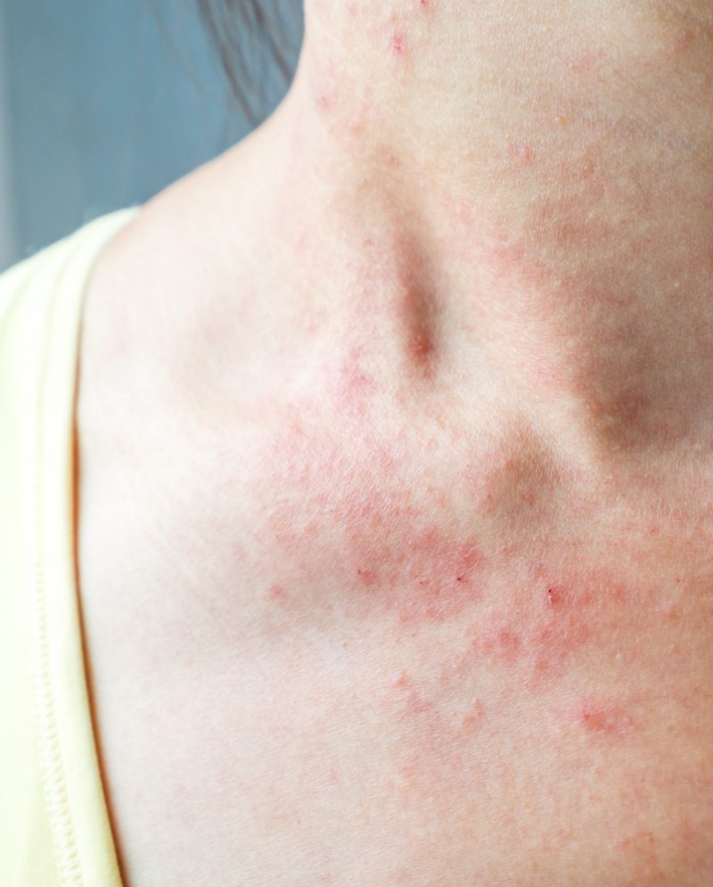 Atopic Dermatitis on a woman's neck