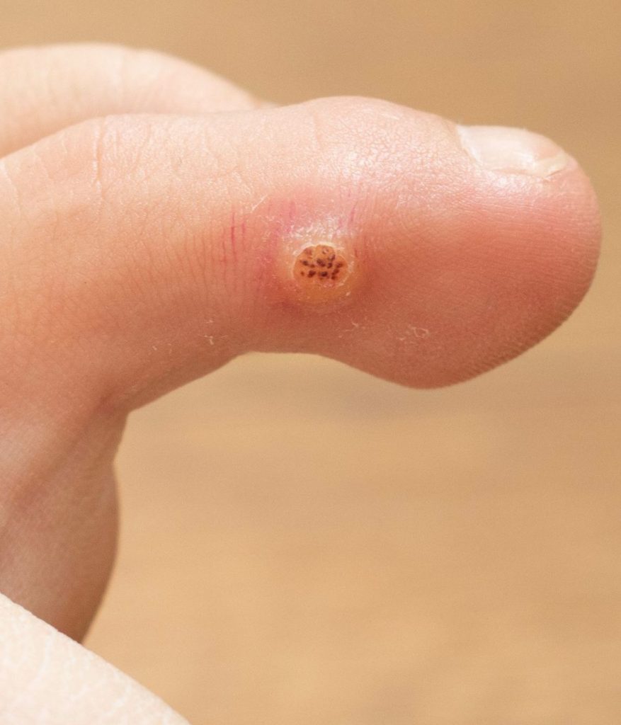 Warts on a person's toe